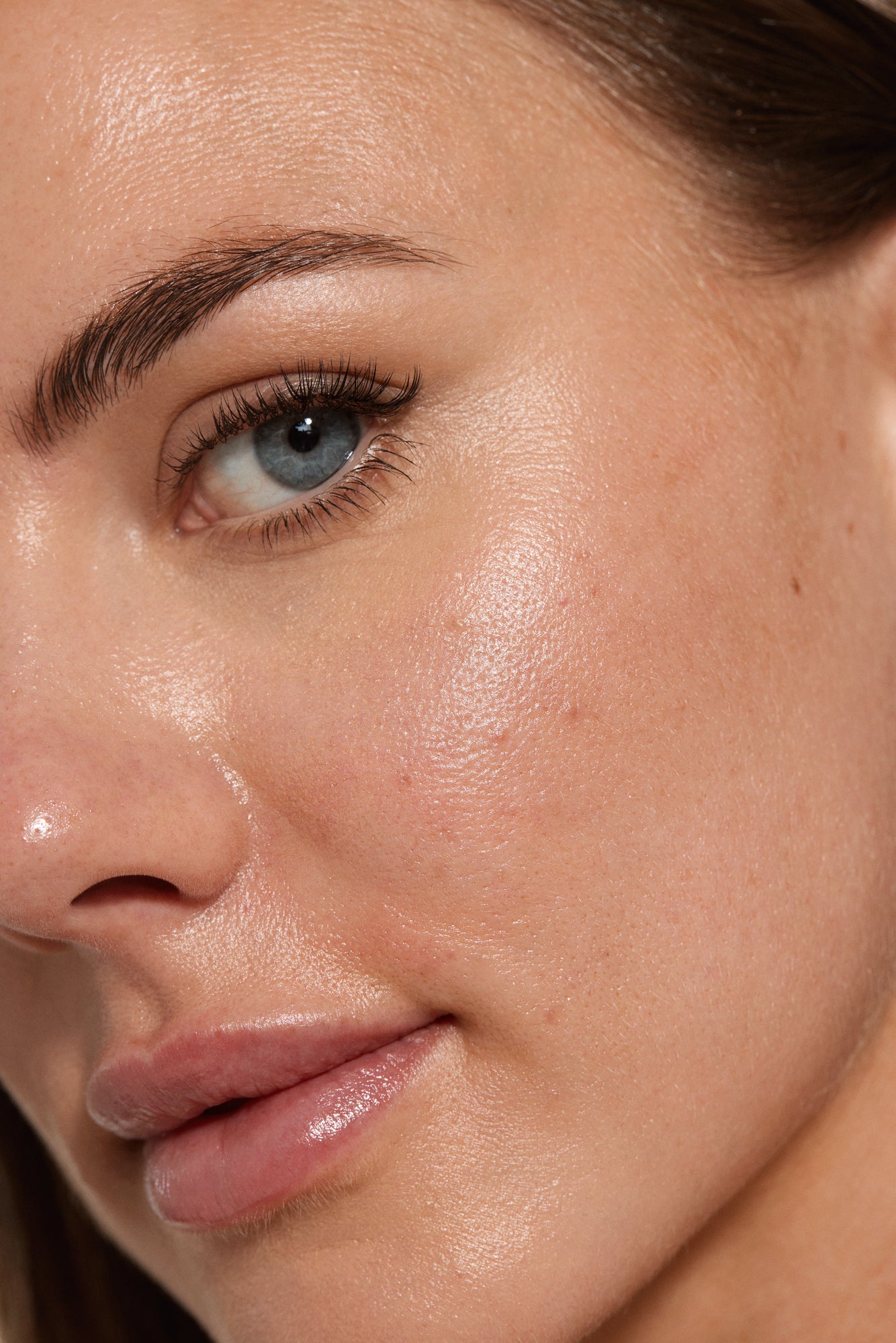 Close-up of a woman's face with minimal acne, demonstrating the effectiveness of medical aesthetic treatments in addressing these skin concerns.