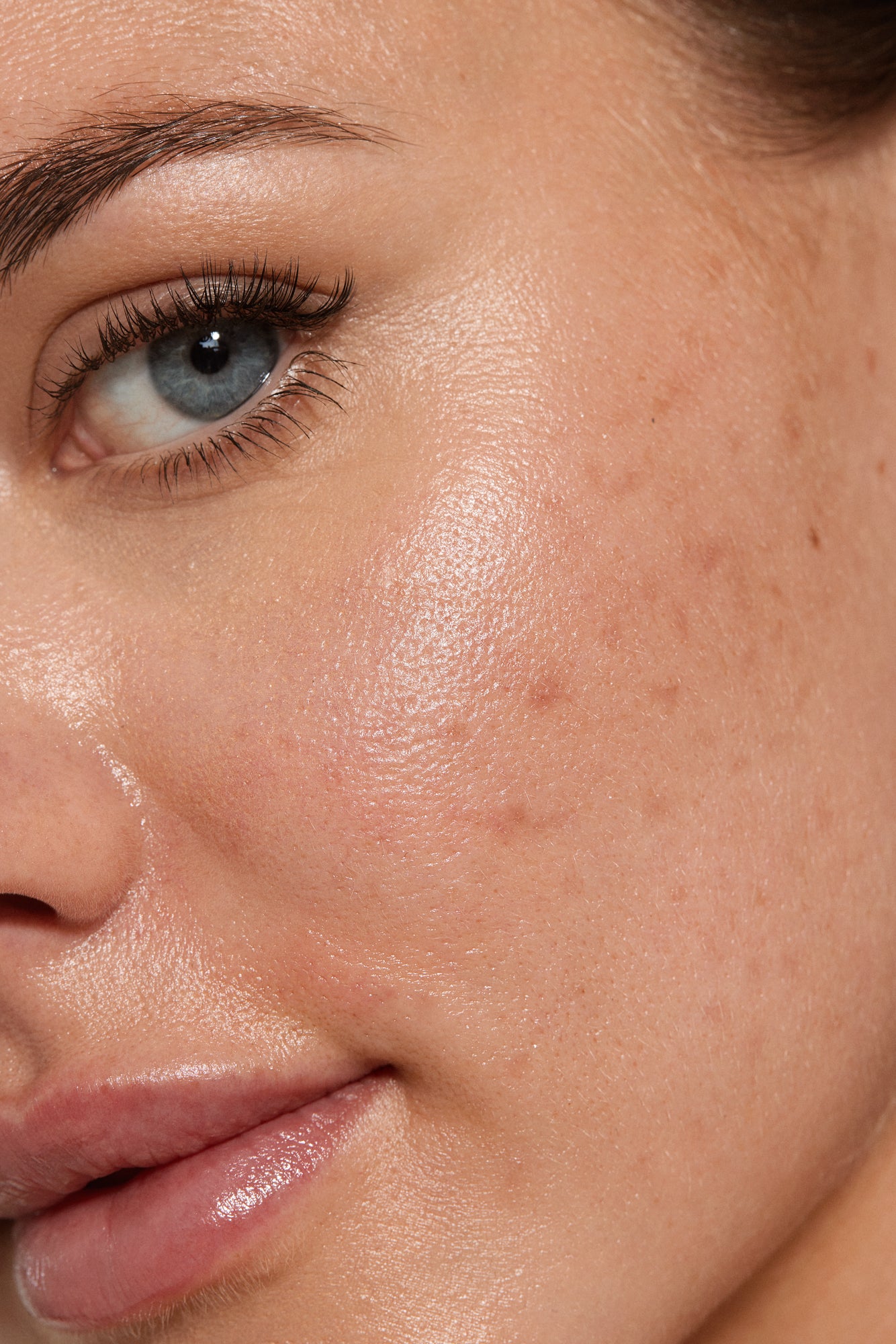 Close-up of a woman's face with minimal acne and dark spots, demonstrating the effectiveness of medical aesthetic treatments in addressing these skin concerns.